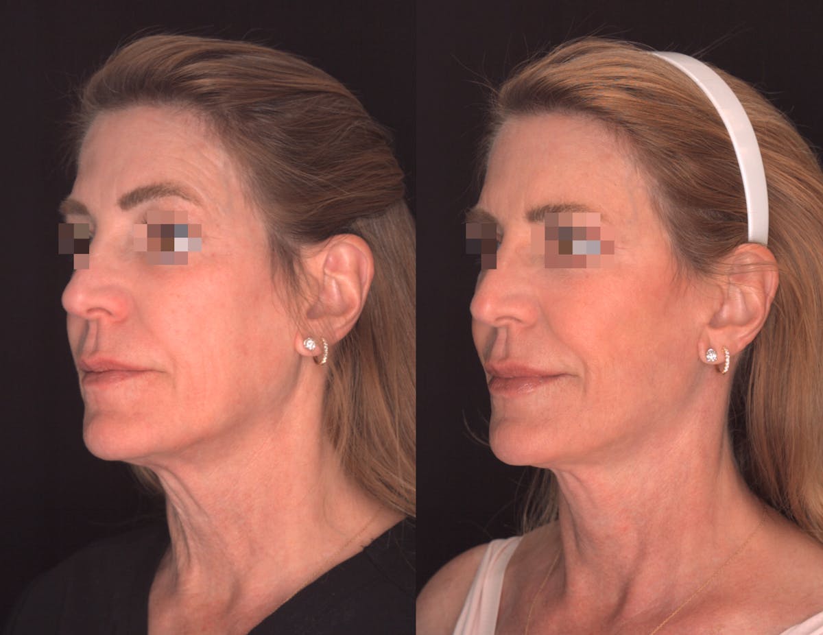 Facelift Female Before & After Gallery - Patient 424489 - Image 2