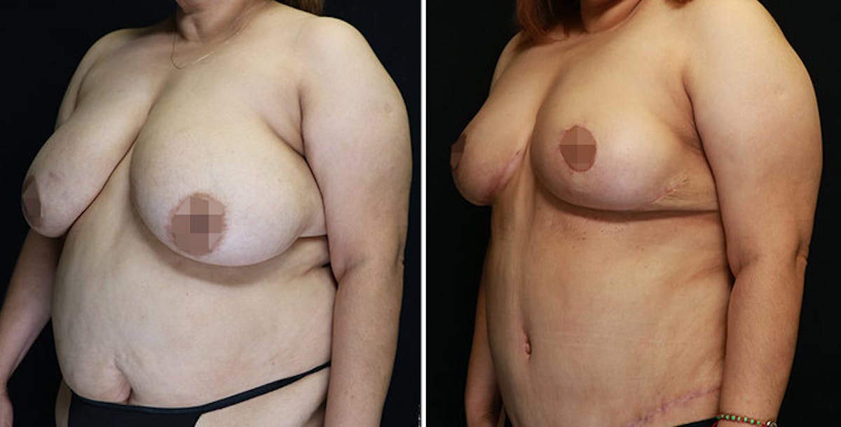 Mommy Makeover Before & After Gallery - Patient 328434 - Image 3