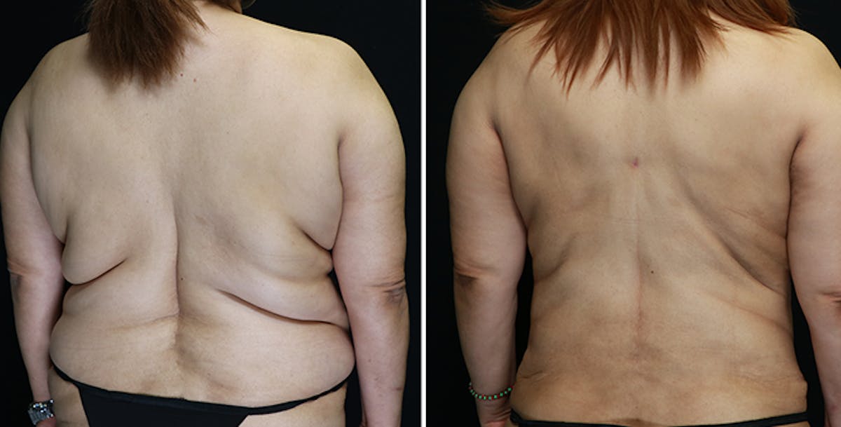 Mommy Makeover Before & After Gallery - Patient 328434 - Image 1