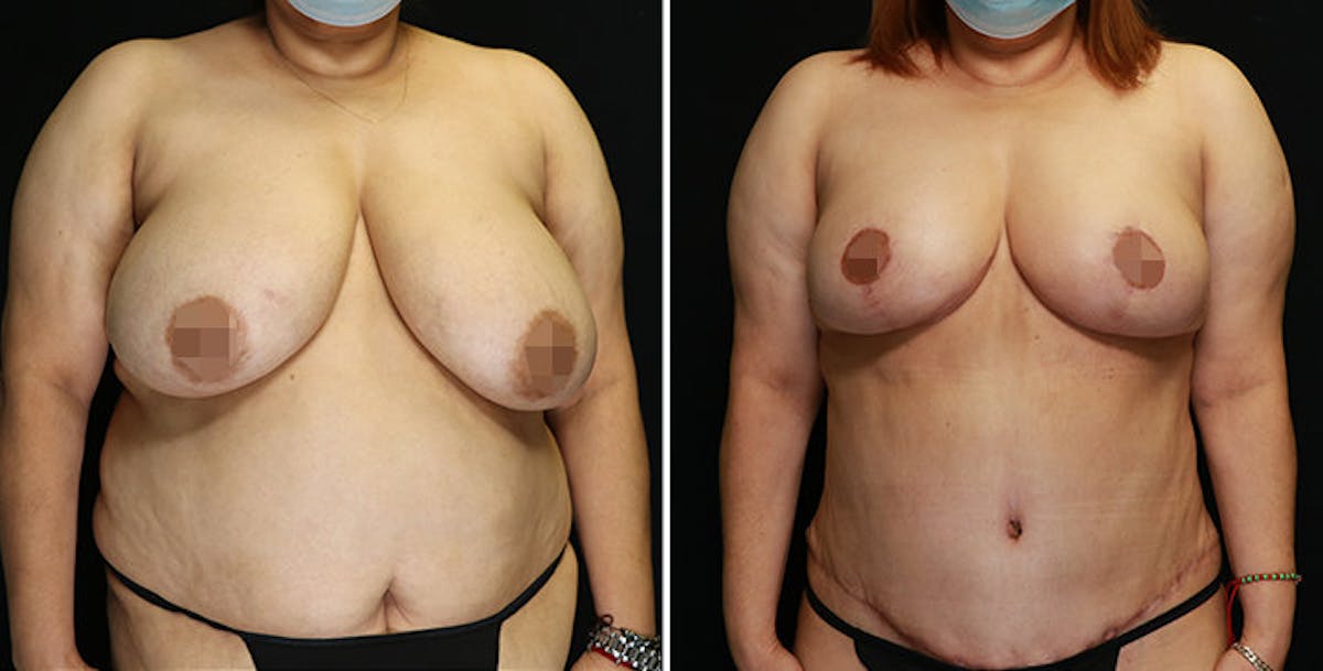 Mommy Makeover Before & After Gallery - Patient 328434 - Image 2