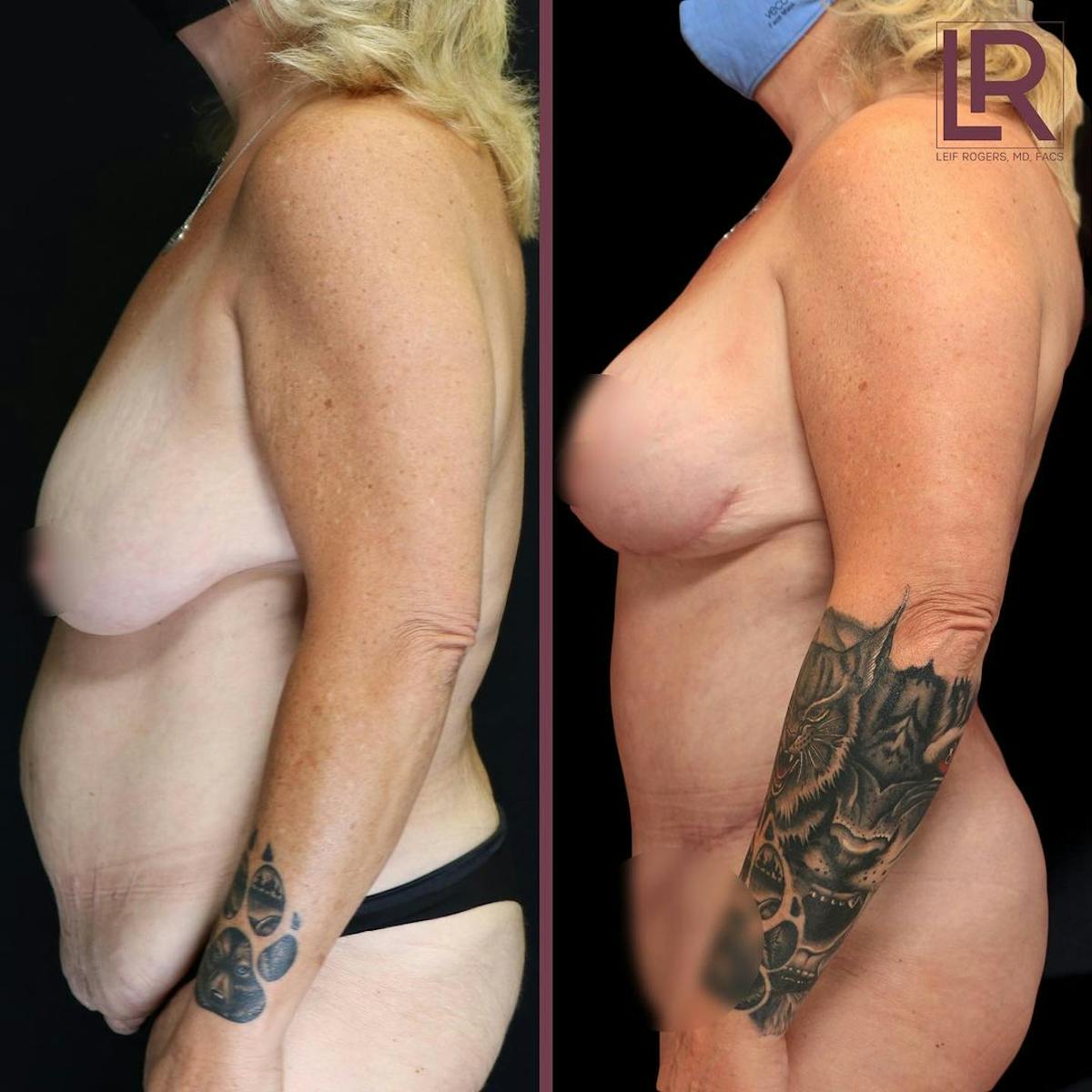 Mommy Makeover Before & After Gallery - Patient 237113 - Image 1
