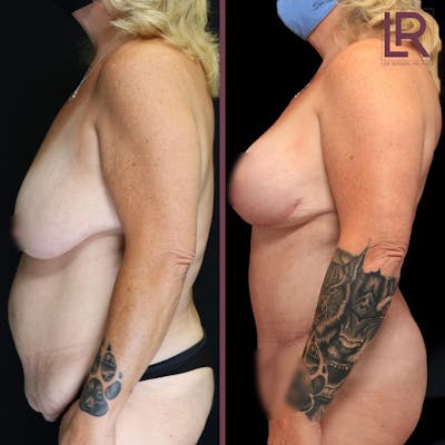Mommy Makeover Before & After Gallery - Patient 237113 - Image 1