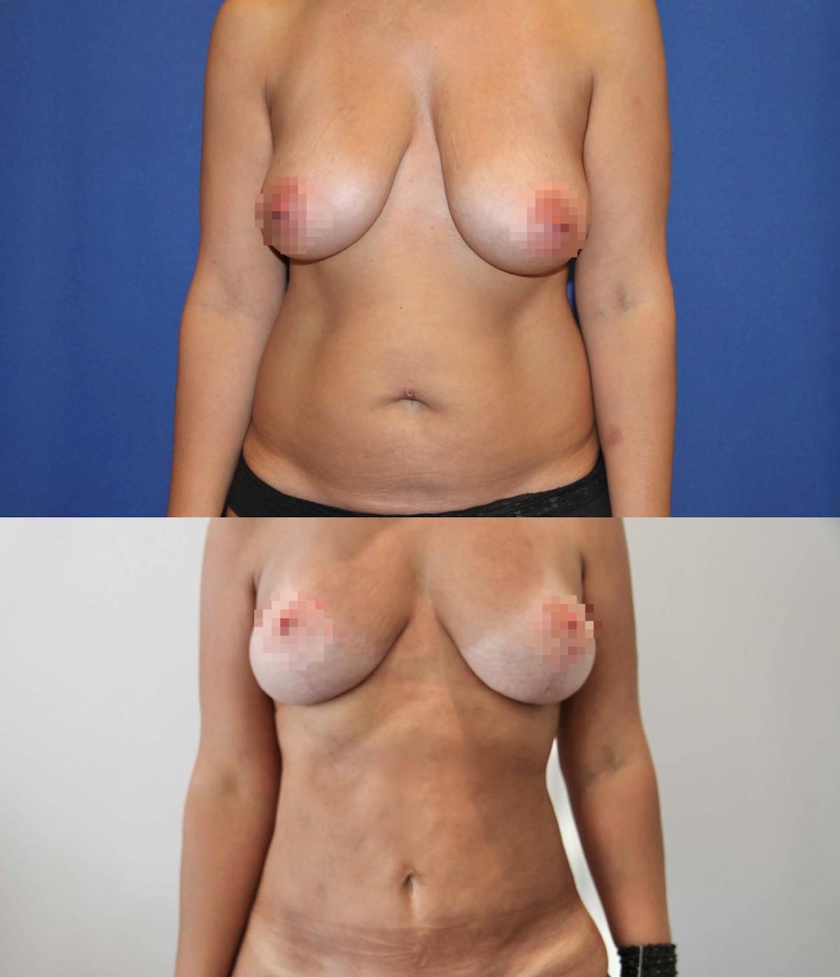 Mommy Makeover Before & After Gallery - Patient 320879 - Image 1