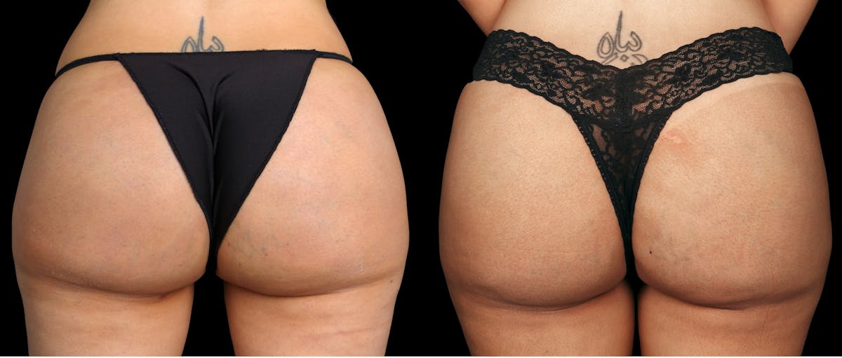 Renuva®  Before & After Gallery - Patient 258700 - Image 1