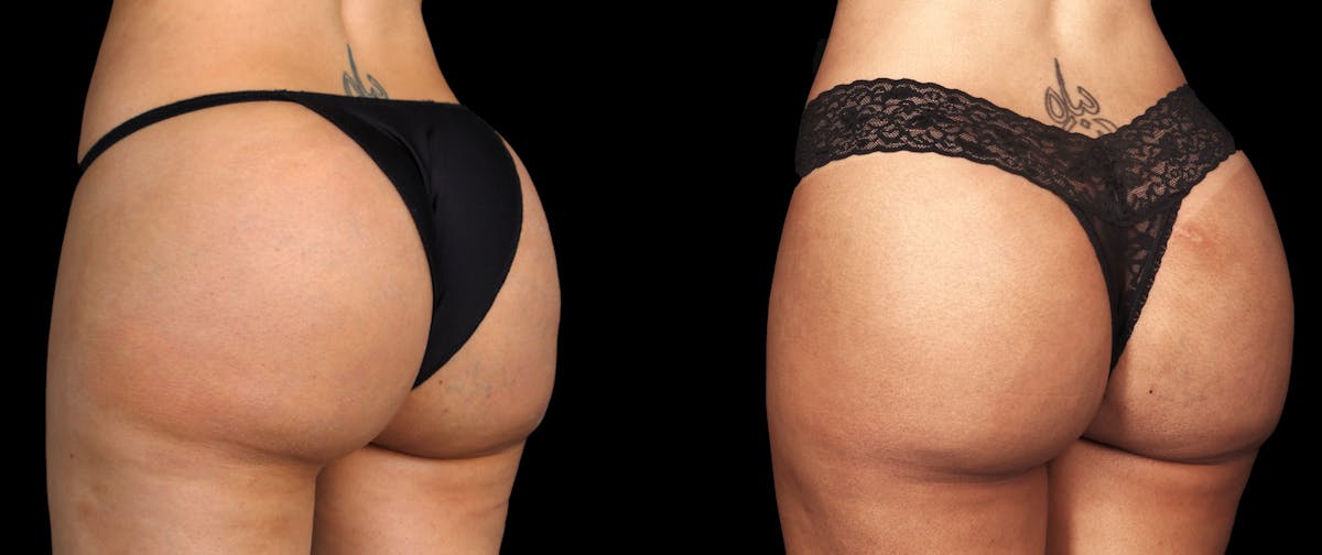 Renuva®  Before & After Gallery - Patient 258700 - Image 2