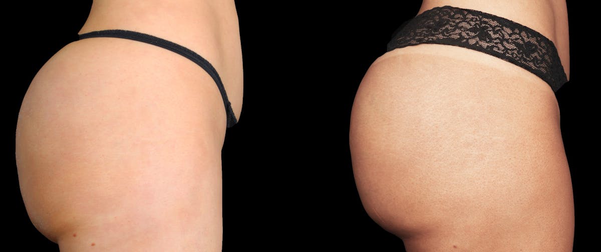 Renuva®  Before & After Gallery - Patient 258700 - Image 3