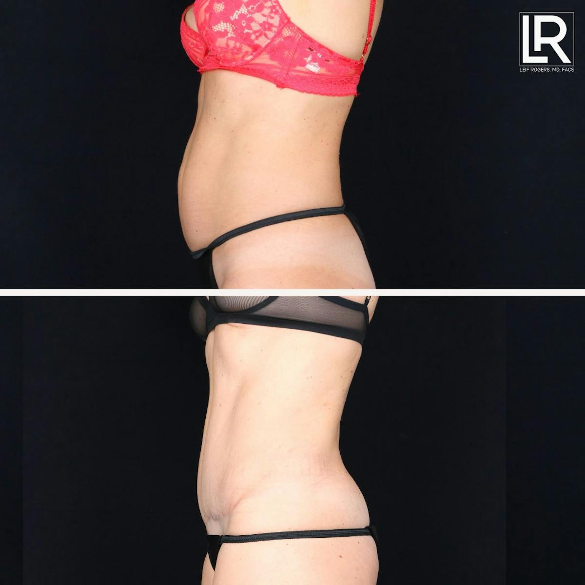 Tummy Tuck Before & After Gallery - Patient 215644 - Image 1