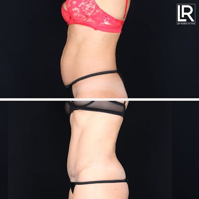 Tummy Tuck Before & After Gallery - Patient 215644 - Image 1