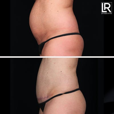 Tummy Tuck Before & After Gallery - Patient 892032 - Image 1