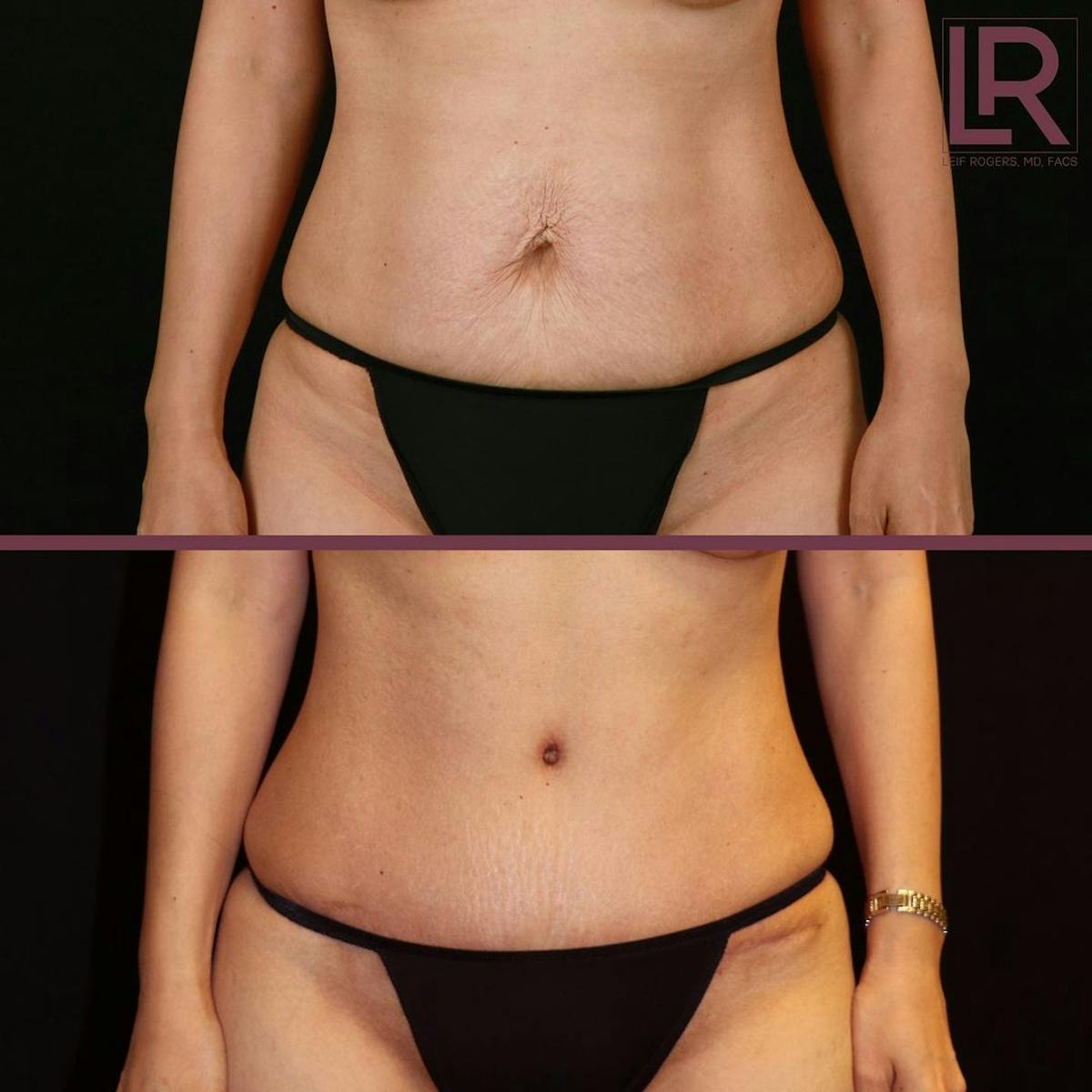 Tummy Tuck Before & After Gallery - Patient 282167 - Image 1