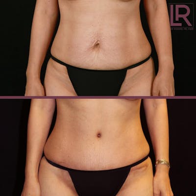 Tummy Tuck Before & After Gallery - Patient 282167 - Image 1