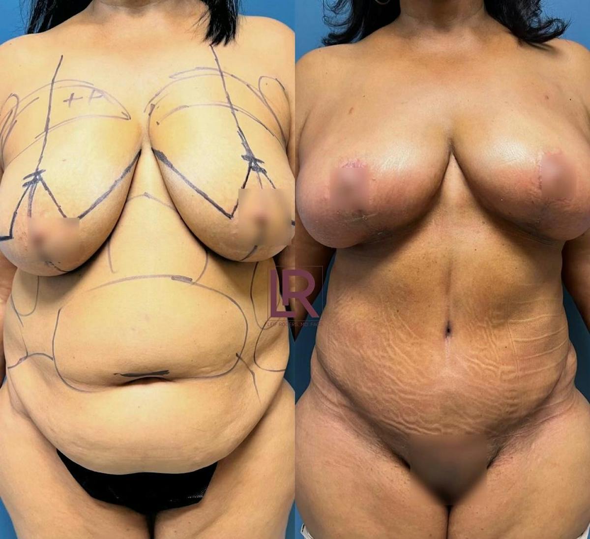 Tummy Tuck Before & After Gallery - Patient 114720 - Image 1