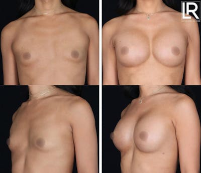 Transgender Breast Augmentation Before & After Gallery - Patient 192485 - Image 1