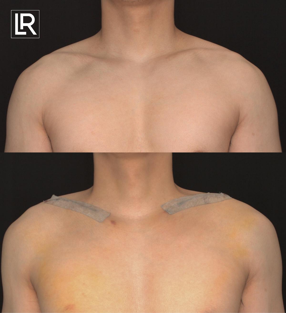 Clavicle Lengthening Before & After Gallery - Patient 714436 - Image 1