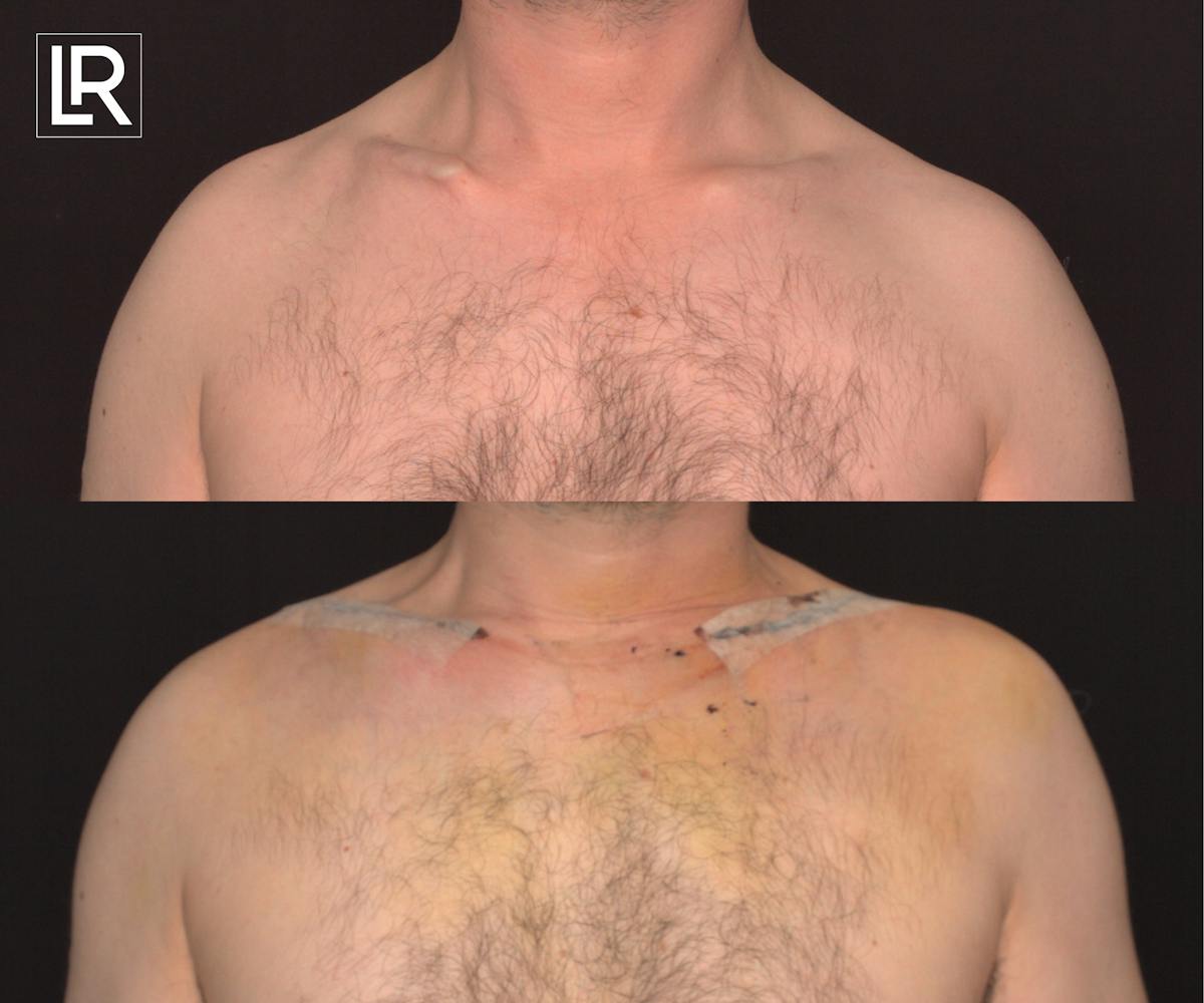 Clavicle Lengthening Before & After Gallery - Patient 199925 - Image 1