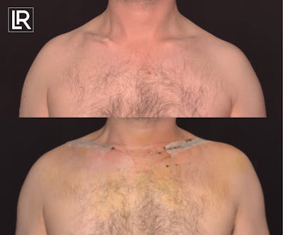 Clavicle Lengthening Before & After Gallery - Patient 199925 - Image 1