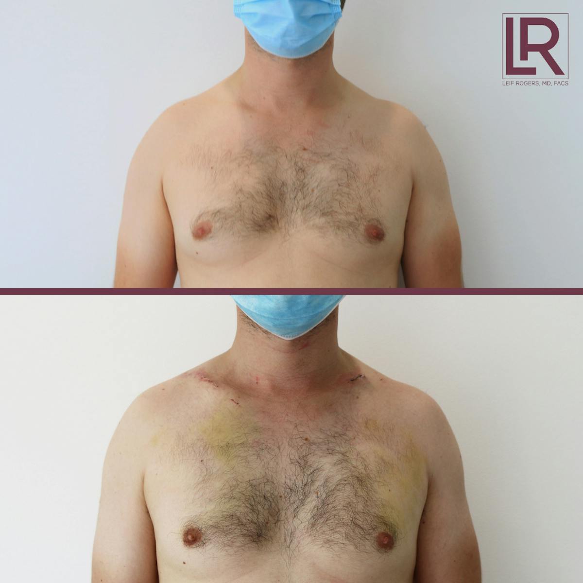 Clavicle Lengthening Before & After Gallery - Patient 544126 - Image 1