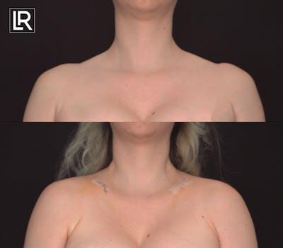 Clavicle Shortening Before & After Gallery - Patient 266436 - Image 1