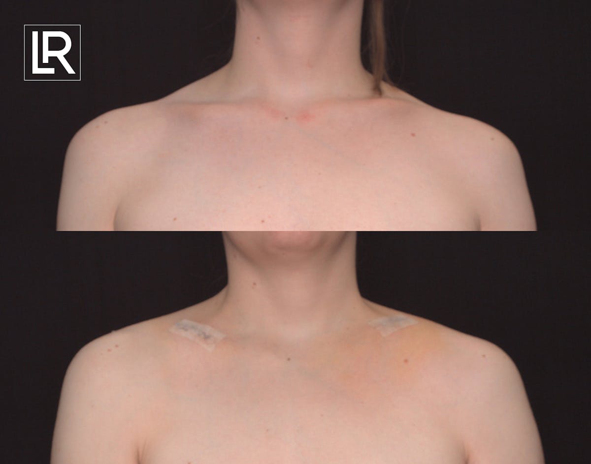 Clavicle Shortening Before & After Gallery - Patient 185218 - Image 1