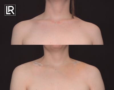 Clavicle Shortening Before & After Gallery - Patient 185218 - Image 1