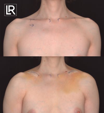 Clavicle Shortening Before & After Gallery - Patient 135317 - Image 1