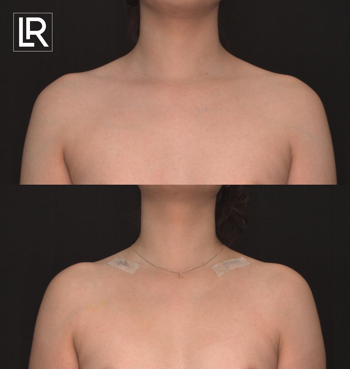 Clavicle Shortening Before & After Gallery - Patient 358597 - Image 1