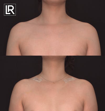 Clavicle Shortening Before & After Gallery - Patient 358597 - Image 1