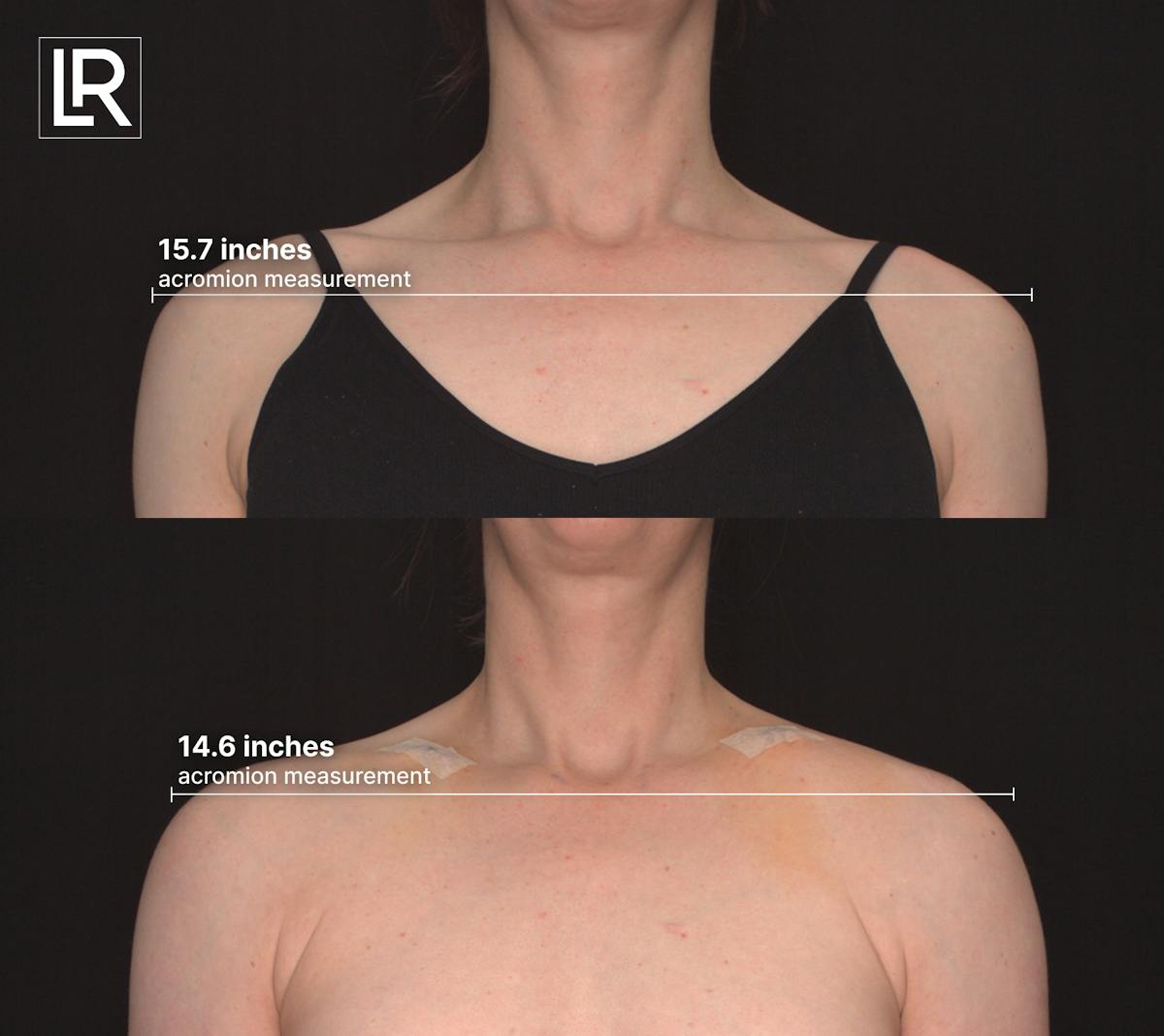Clavicle Shortening Before & After Gallery - Patient 492972 - Image 1