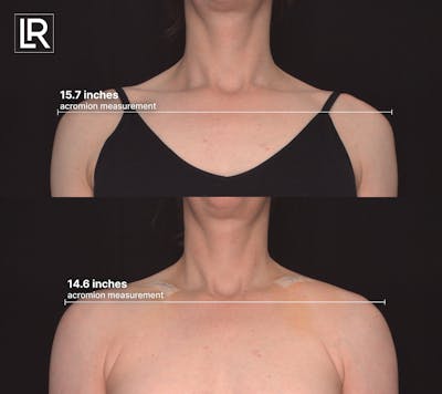 Clavicle Shortening Before & After Gallery - Patient 492972 - Image 1