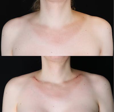 Clavicle Shortening Before & After Gallery - Patient 175648 - Image 1