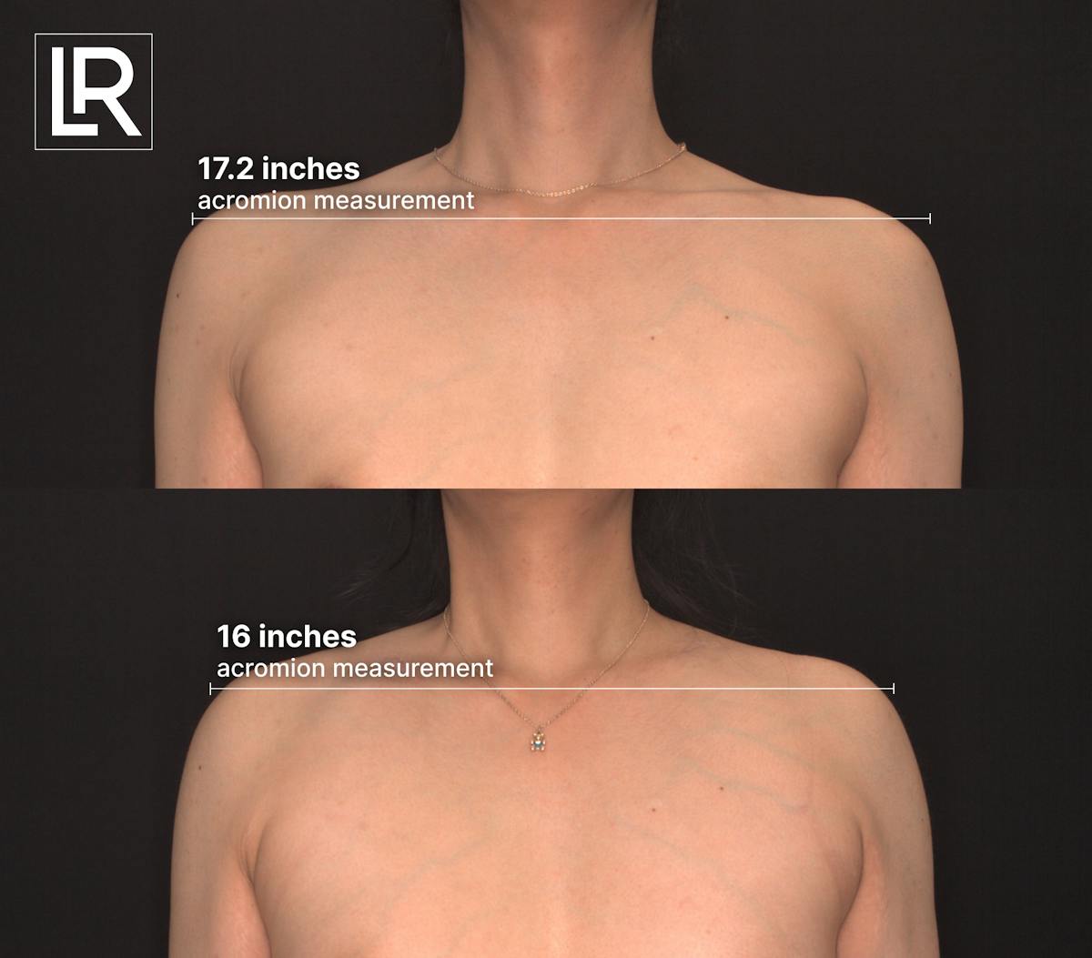 Clavicle Shortening Before & After Gallery - Patient 242455 - Image 1