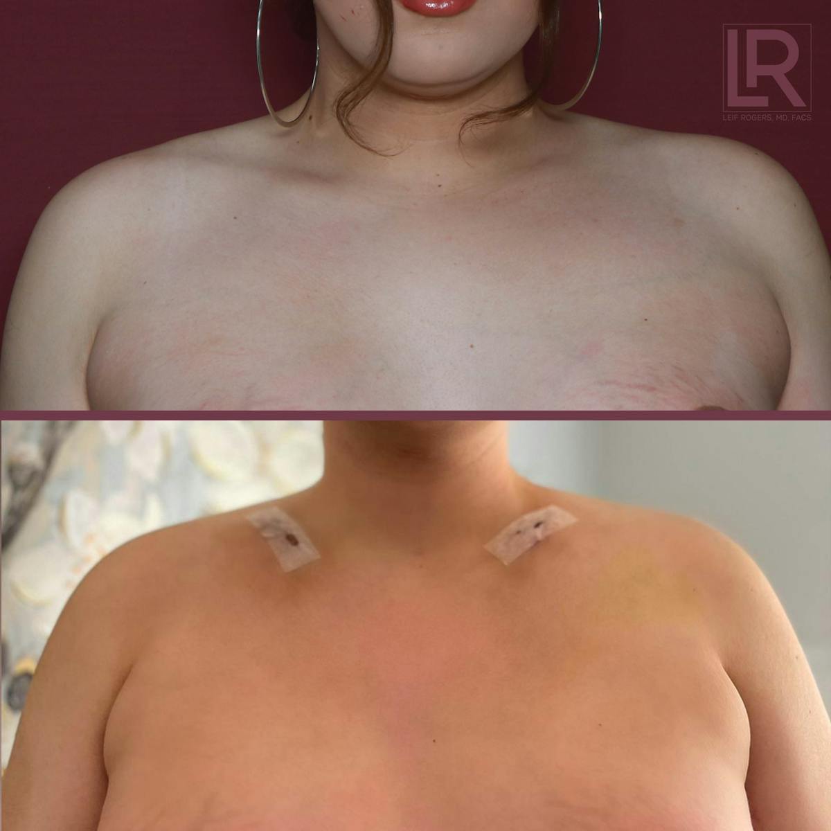 Clavicle Shortening Before & After Gallery - Patient 291363 - Image 1
