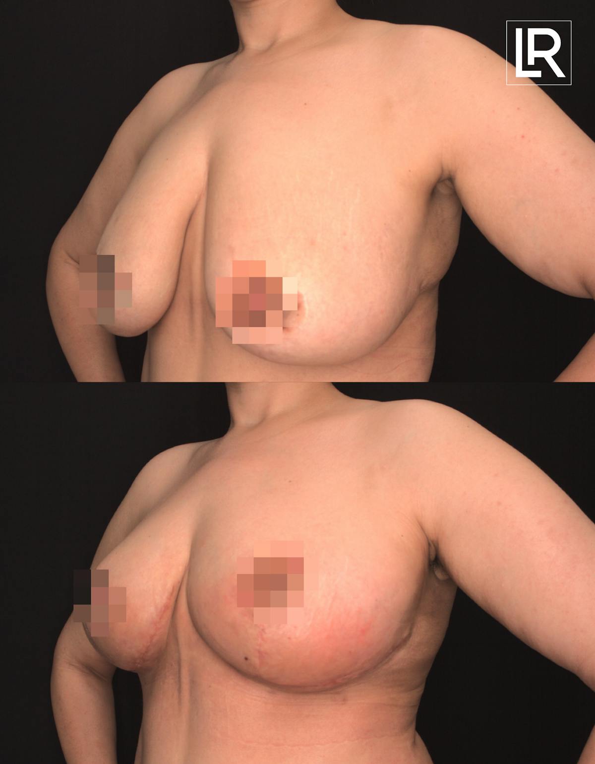 Arm Lift Before & After Gallery - Patient 412184 - Image 2