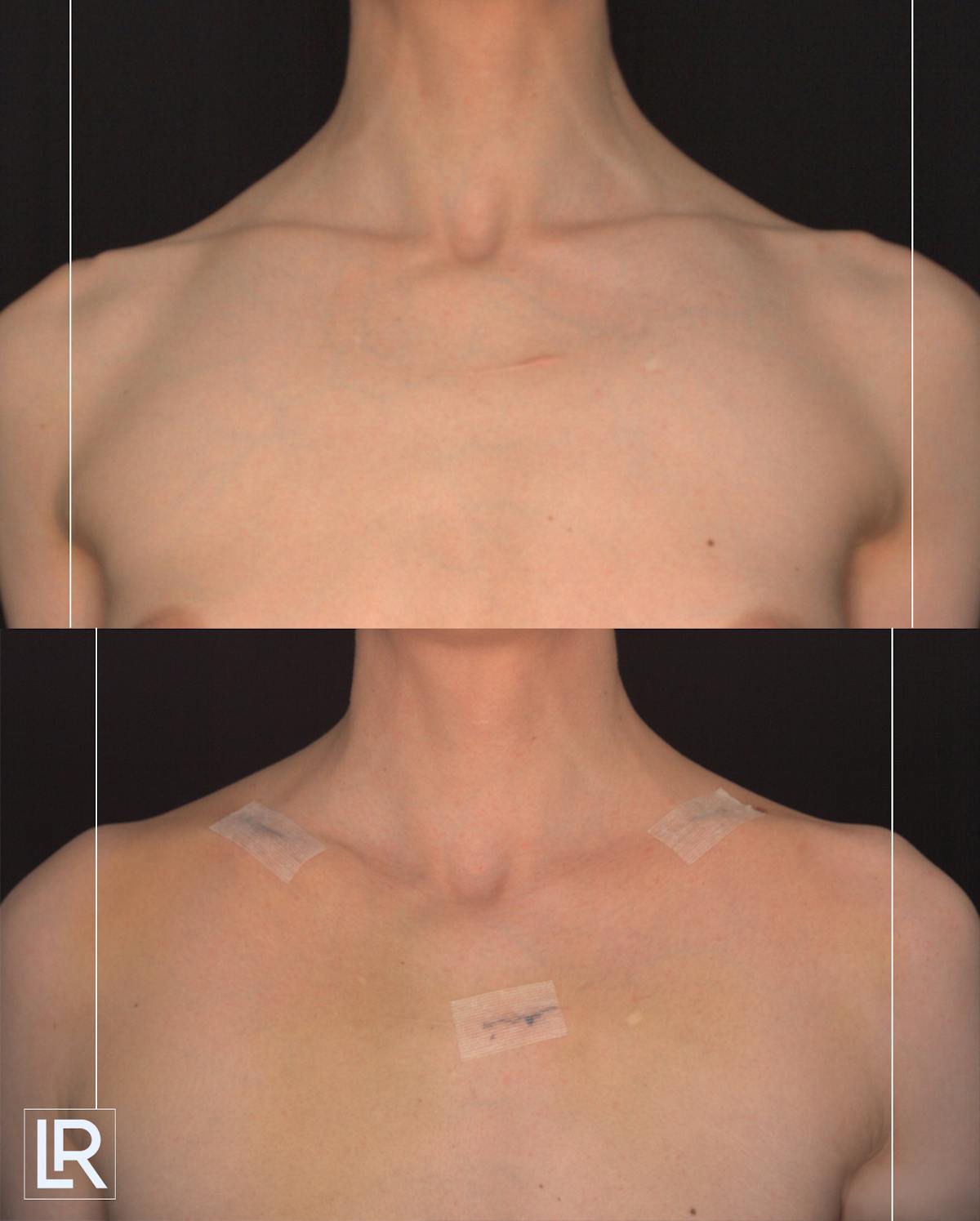 Clavicle Shortening Before & After Gallery - Patient 135553 - Image 1