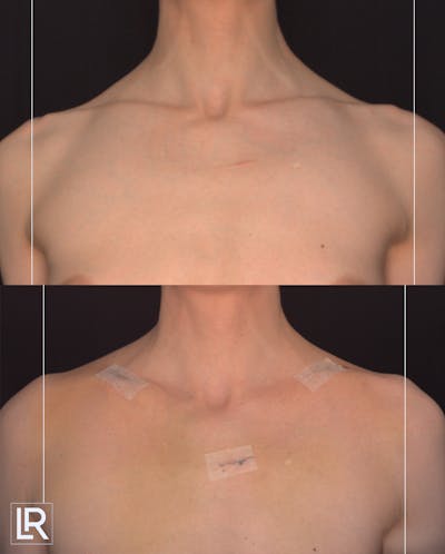 Clavicle Shortening Before & After Gallery - Patient 135553 - Image 1