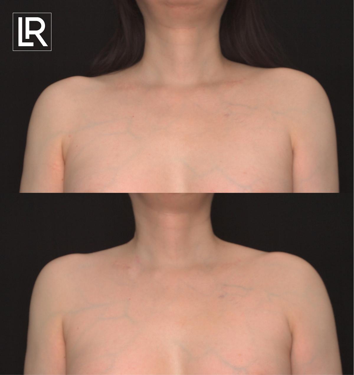 Clavicle Shortening Before & After Gallery - Patient 126570 - Image 1