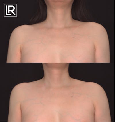 Clavicle Shortening Before & After Gallery - Patient 126570 - Image 1