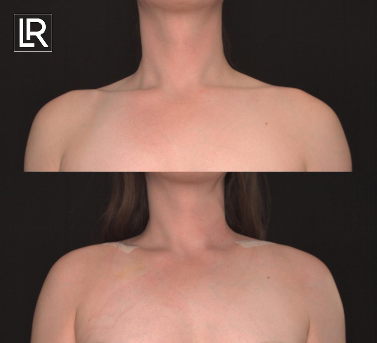 Clavicle Shortening Before & After Gallery - Patient 325469 - Image 1