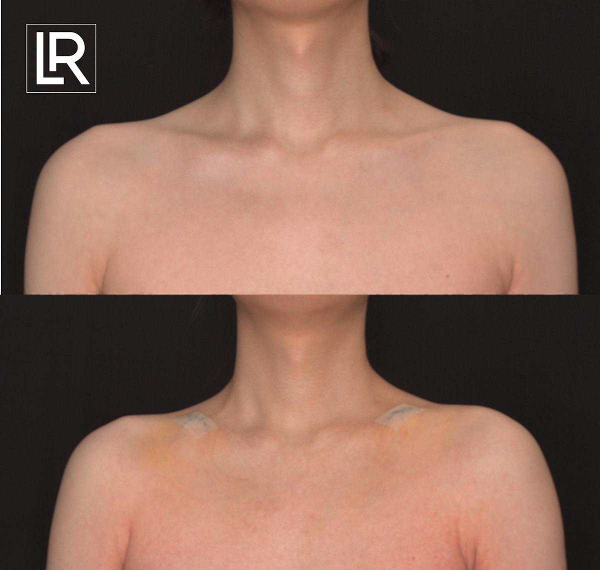 Clavicle Shortening Before & After Gallery - Patient 359042 - Image 1