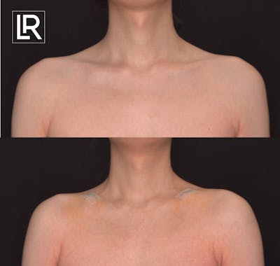 Clavicle Shortening Before & After Gallery - Patient 359042 - Image 1
