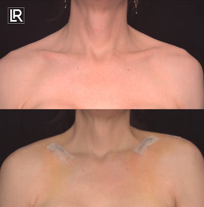 Clavicle Shortening Before & After Gallery - Patient 384721 - Image 1