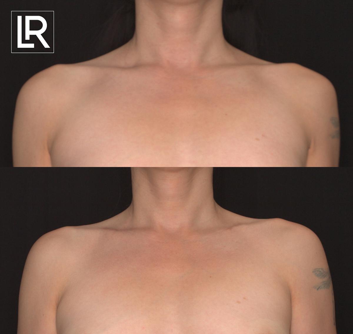 Clavicle Shortening Before & After Gallery - Patient 381473 - Image 1