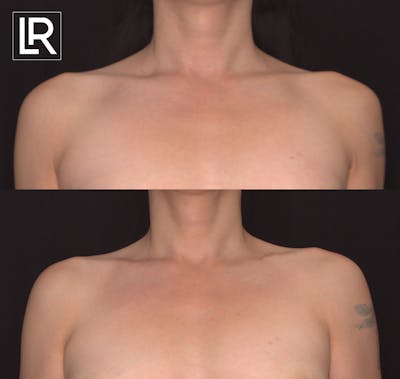 Clavicle Shortening Before & After Gallery - Patient 381473 - Image 1