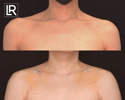 Clavicle Shortening Before & After Gallery - Patient 341411 - Image 1