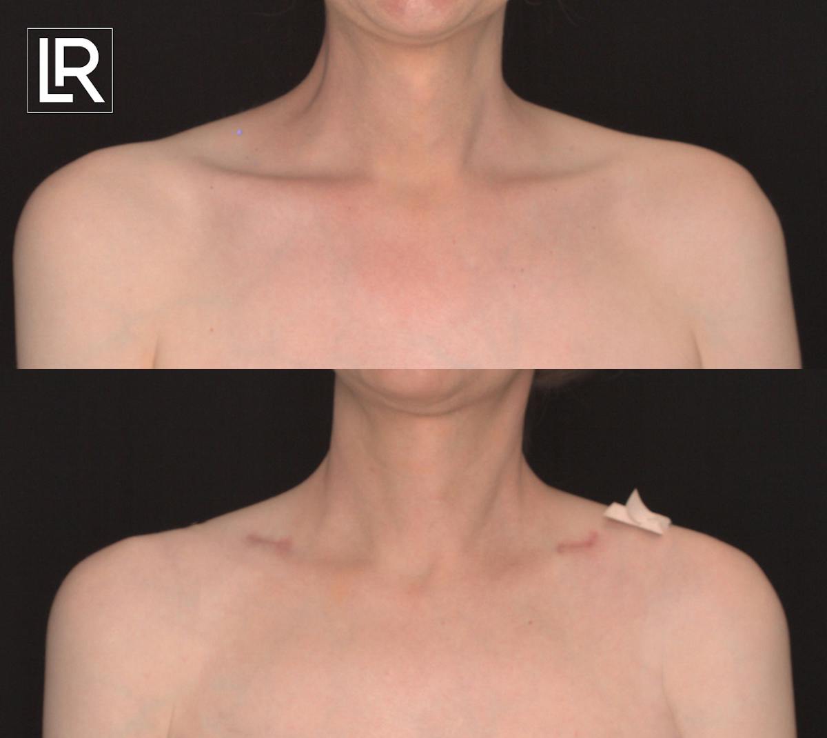 Clavicle Shortening Before & After Gallery - Patient 125978 - Image 1