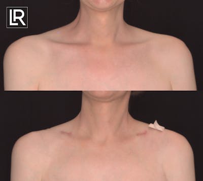 Clavicle Shortening Before & After Gallery - Patient 125978 - Image 1