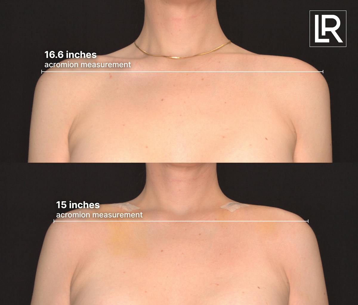Clavicle Shortening Before & After Gallery - Patient 246033 - Image 1