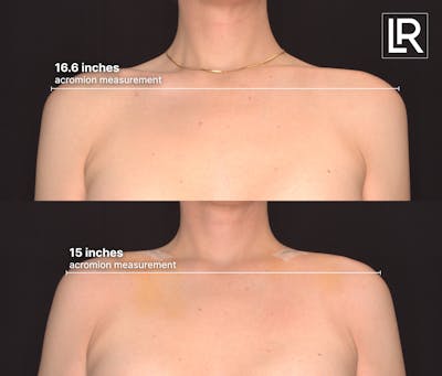 Clavicle Shortening Before & After Gallery - Patient 246033 - Image 1