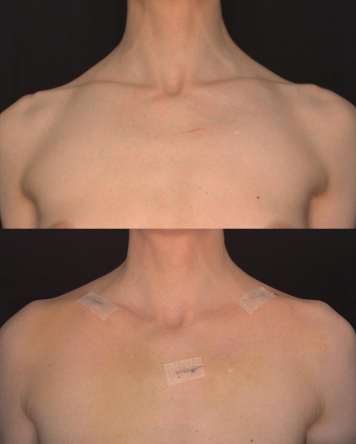 Clavicle Shortening Before & After Gallery - Patient 388404 - Image 1