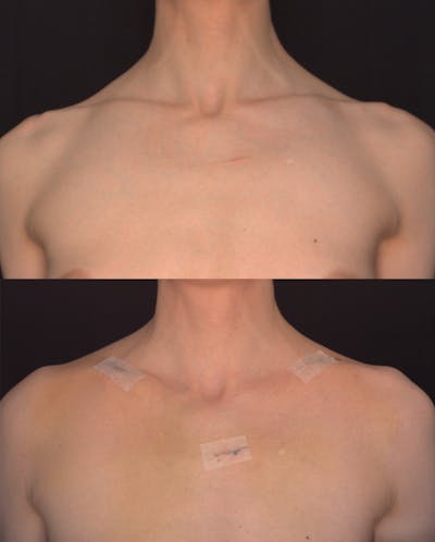 Clavicle Shortening Before & After Gallery - Patient 388404 - Image 1